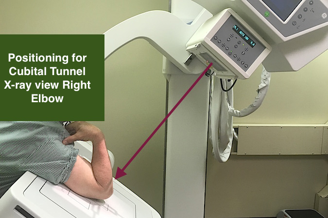 CUBITAL TUNNEL SYNDROME Hand Surgery Resource cubital-tunnel-syndrome-hand-surgery-resource